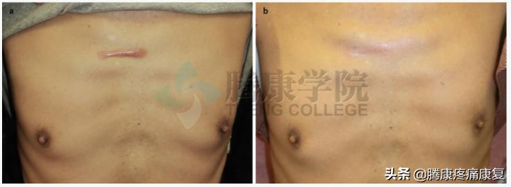 增生性瘢痕和瘢痕疙瘩的鉴别诊断,皮质类固醇贴