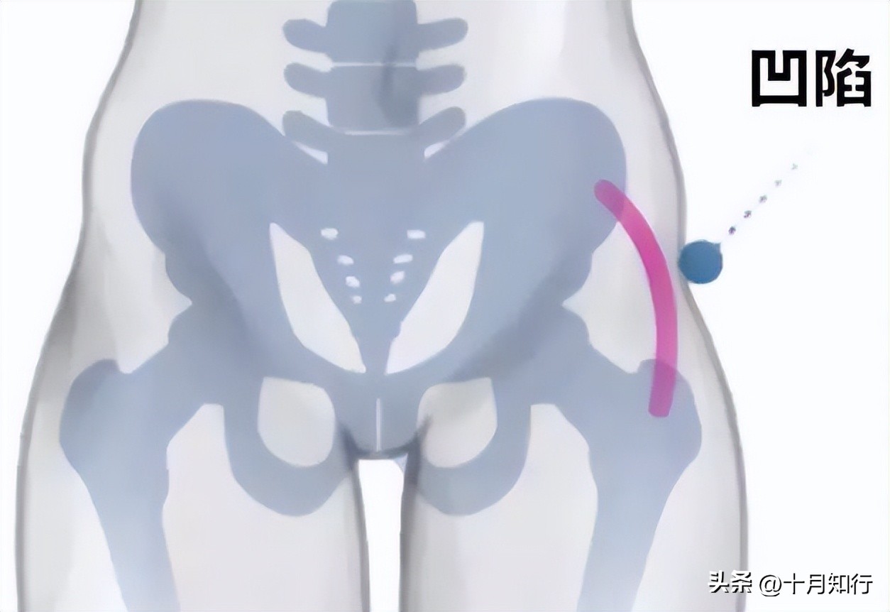 臀部下垂两侧凹陷怎样能提升臀线,怎样改善臀部两侧凹陷和提臀