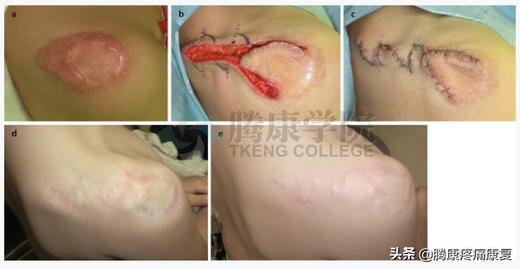 增生性瘢痕和瘢痕疙瘩的鉴别诊断,皮质类固醇贴