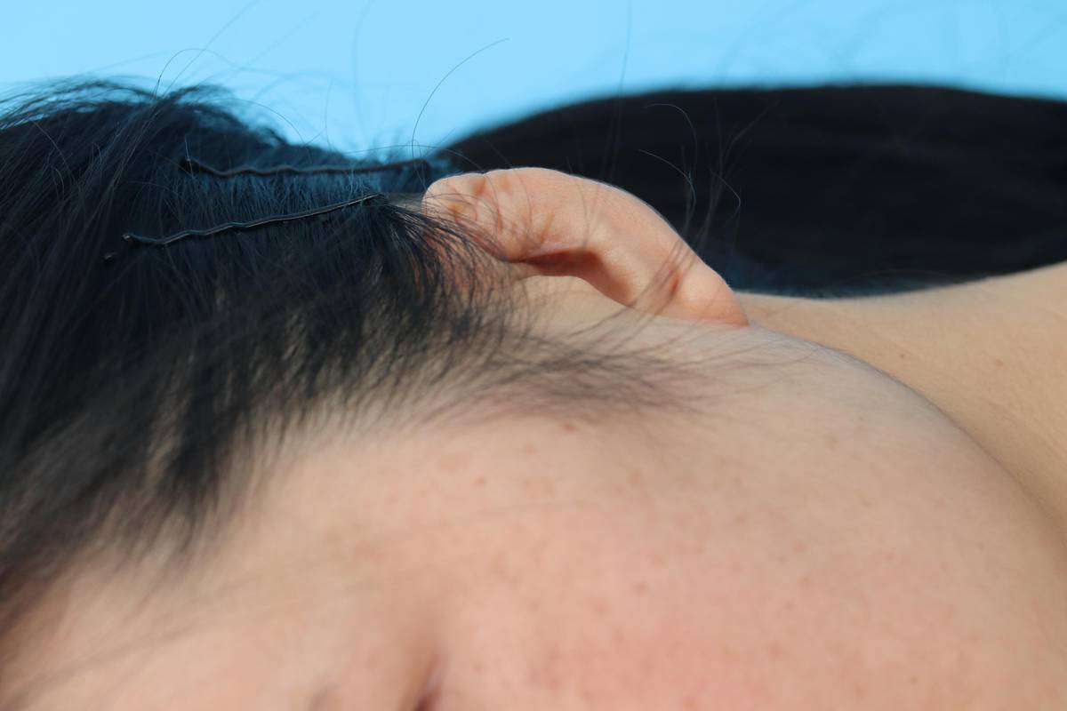 耳软骨隆鼻会塌下来吗,软骨隆鼻鼻小柱会塌吗