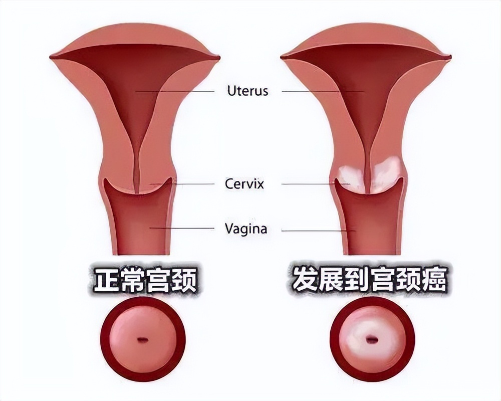定期筛查宫颈癌有多重要？
