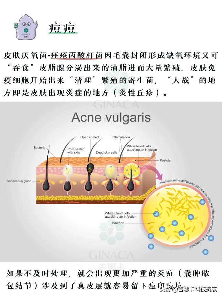如何祛痘的方法最有效,怎样祛痘最快最有效10个小方法