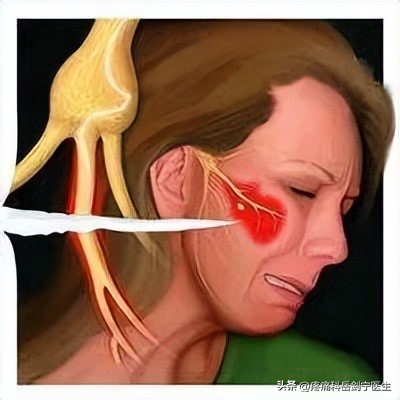 三叉神经痛如何鉴别诊断呢,三叉神经痛真实视频