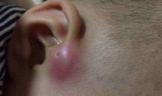 孩子耳朵有一个洞,小孩耳朵耳膜有一个小小的洞