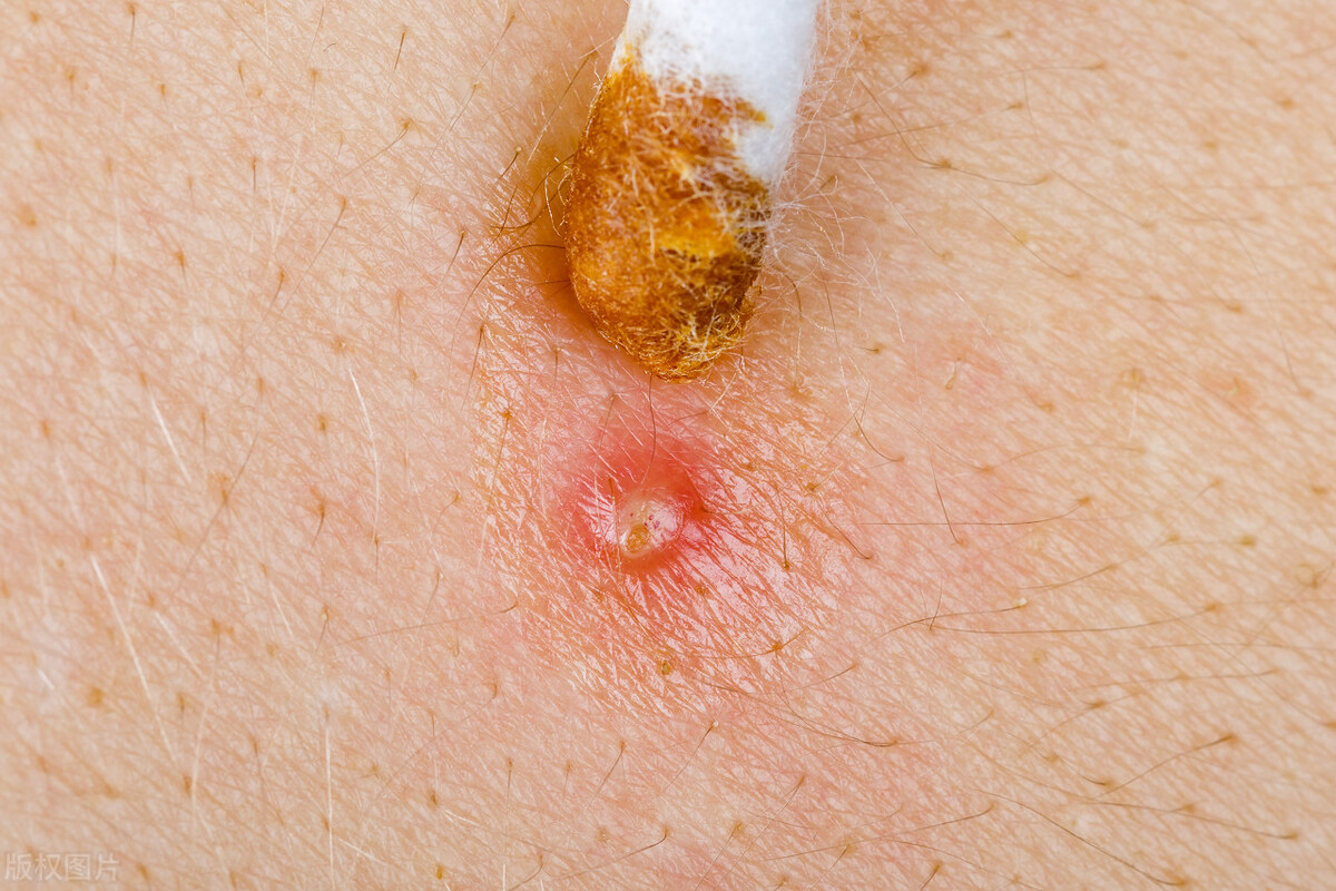 什么是毛囊炎危险三角区,什么是毛囊炎