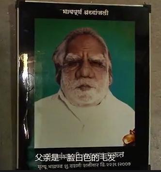 故事:非洲17岁女孩长满络腮胡,毛发从鼻孔长到脖子,身体有何异常