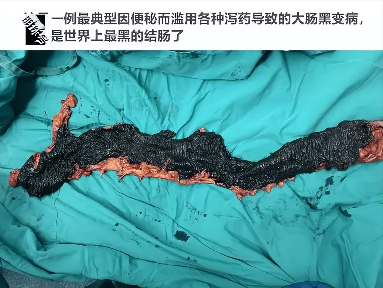 女子四处求医治便秘,结果走一大圈弯路,专家:我有一个更好方案