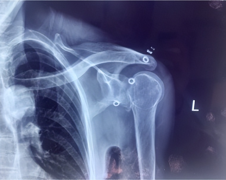 陈旧性肩关节脱臼有必要做手术吗,多年陈旧性肘关节脱臼