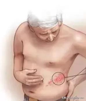 60岁以上接种哪种带状疱疹疫苗,带状疱疹病毒好治疗吗