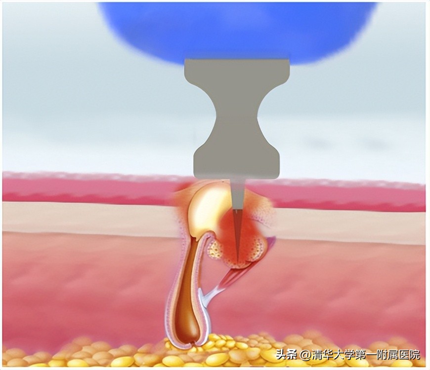 2023一起美起来丨过完年，你长痘了吗？