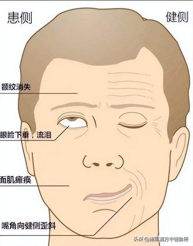 焦虑症导致的面瘫能自愈吗,面瘫早期治疗处方