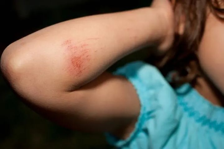 疤痕膏哪种效果最好,效果好的疤痕膏有哪些