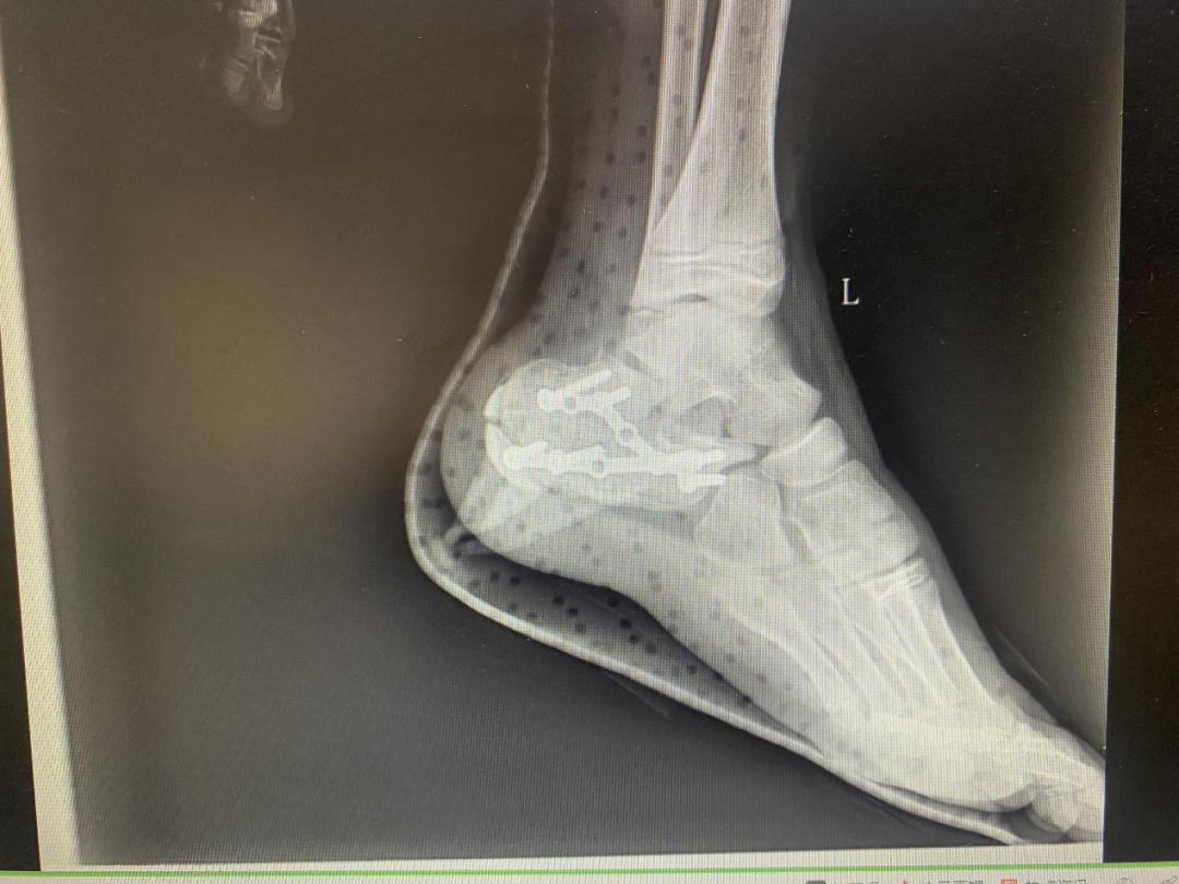 跗骨窦手术能治好吗,跗骨窦入路治疗跟骨骨折适应症