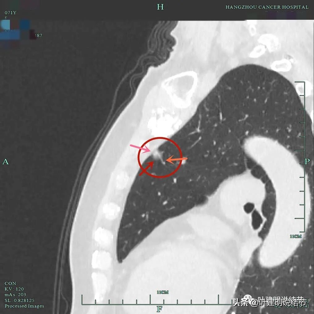 右下叶磨玻璃6mm结节基本上是癌,右下叶少许炎症上叶磨玻璃结节