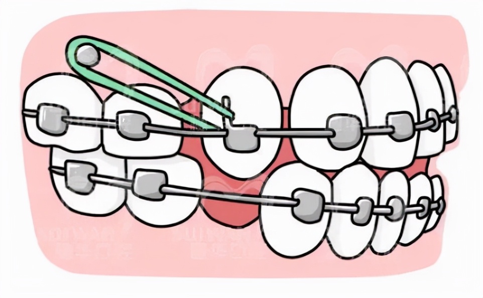 正畸牙套皮筋的绑法,牙套上的皮筋怎么快速戴
