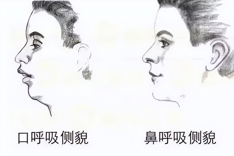 河南儿科专家黄甡腺样体肥大,儿童腺样体肥大的危害你了解多少