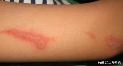 夏天虫咬皮炎的治疗方法,虫咬性皮炎到底如何杀虫