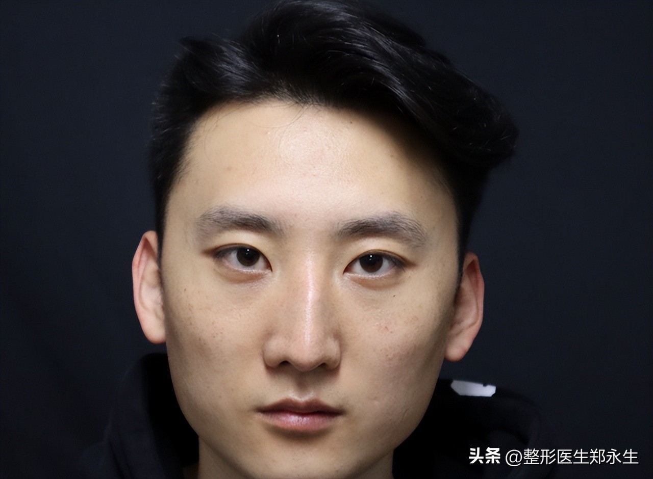 歪鼻子如何整形,歪鼻手术案例男