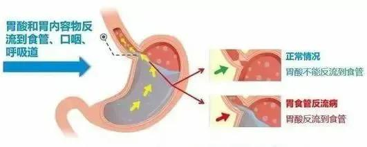 渭南妇幼打无痛,手术麻醉为什么不能吃喝