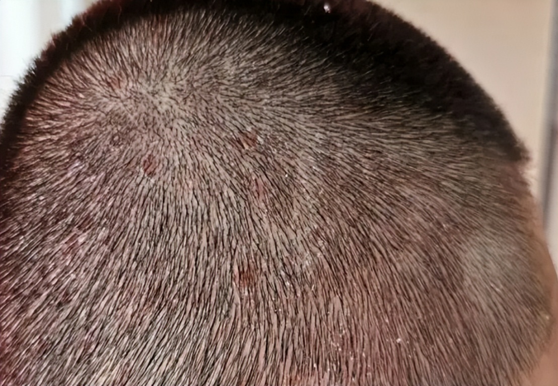 头皮上摸到一个硬疙瘩,头皮有小疙瘩摸着疼怎么回事