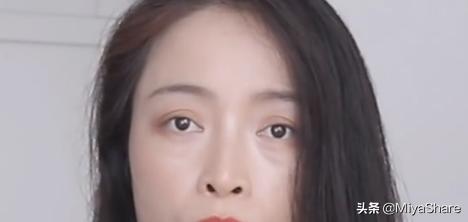 拖了一年的手术,眼袋手术5年后的感受