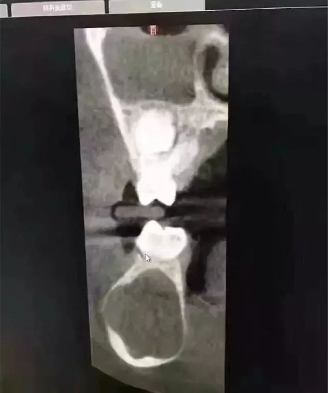 乳牙坏了能让你破费六位数，你信吗？