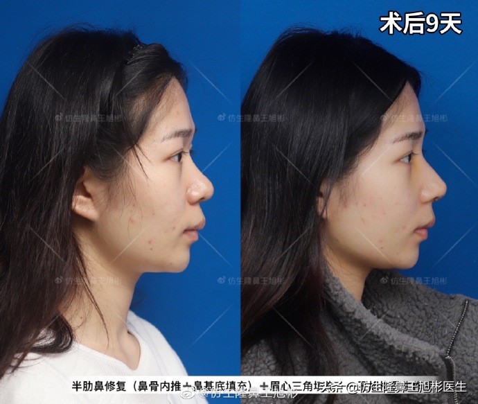 常见鼻部整形美容项目,整形鼻和自然鼻