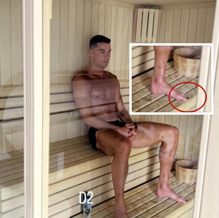 c罗脚部的变化,c罗的脚趾甲为什么是黑的