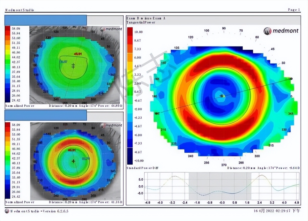 角膜接触镜验配案例图解,戴角膜塑形镜反复出现点染的原因