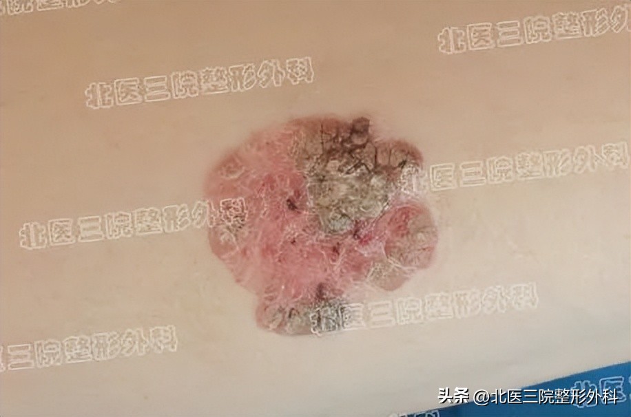 按“湿疹”治了多年的红斑发现是恶性的