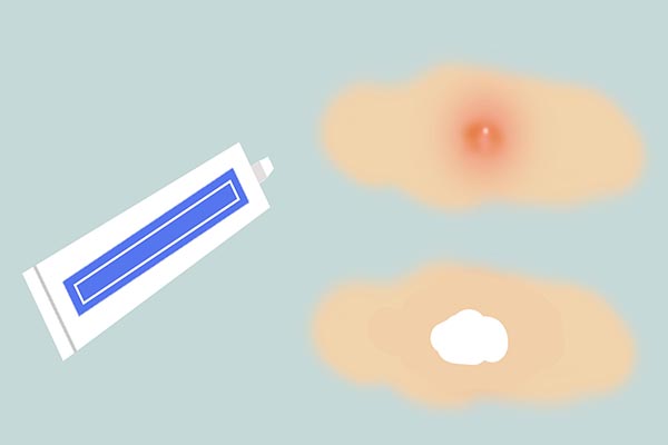 红霉素软膏可以去除老年斑吗,红霉素软膏祛老年斑小妙招