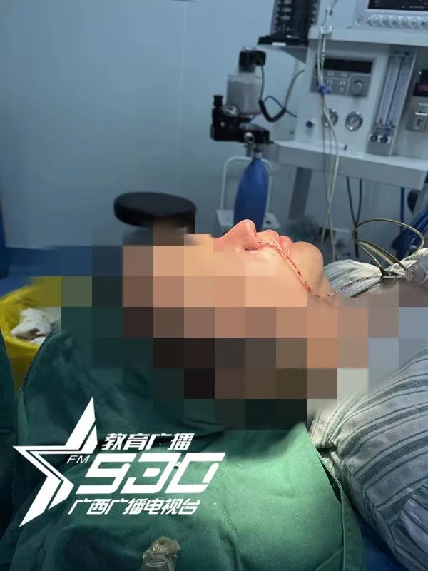 女子花1万隆鼻后山根塌陷,女子花9万多隆鼻