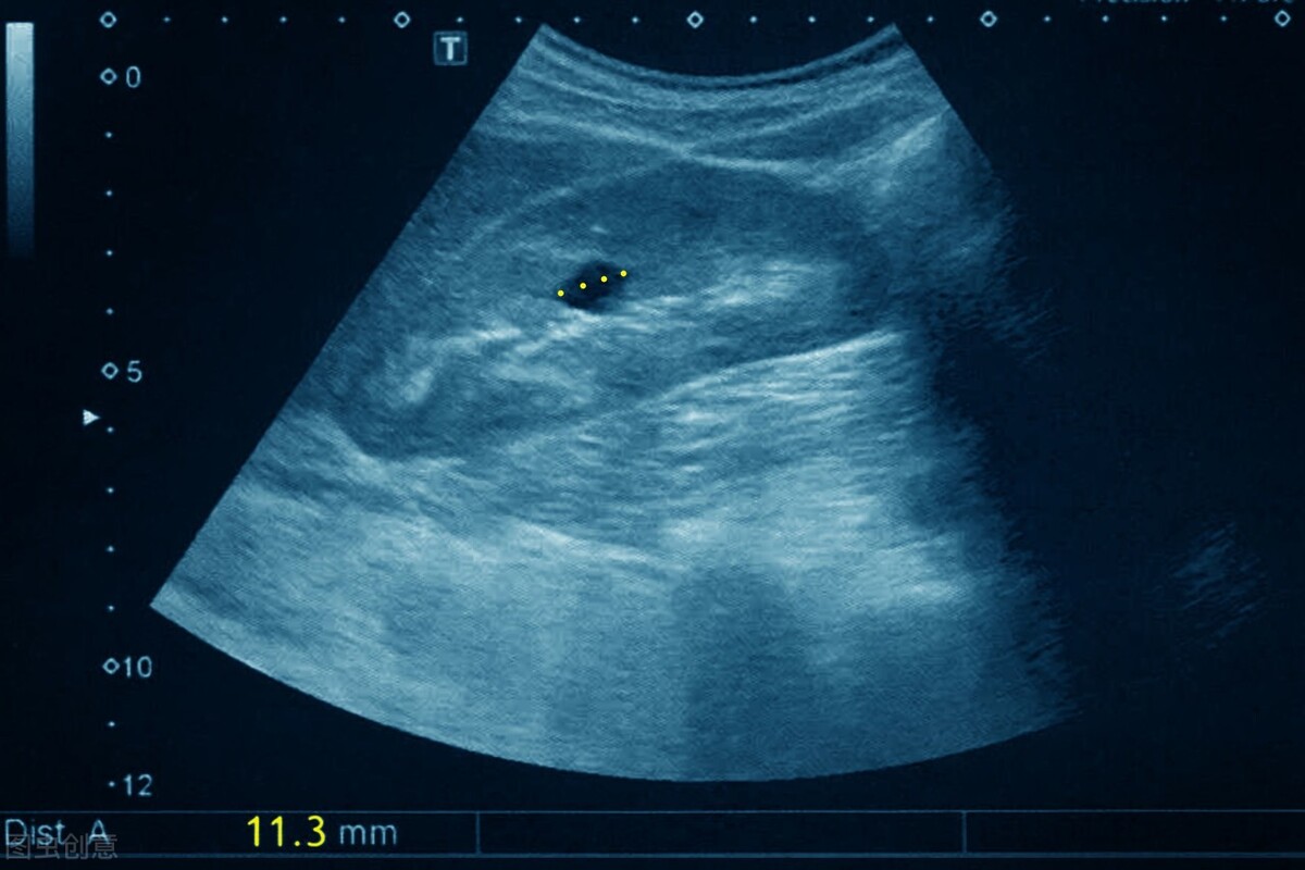 医生说是囊肿是什么意思,已经形成囊肿了怎么消除