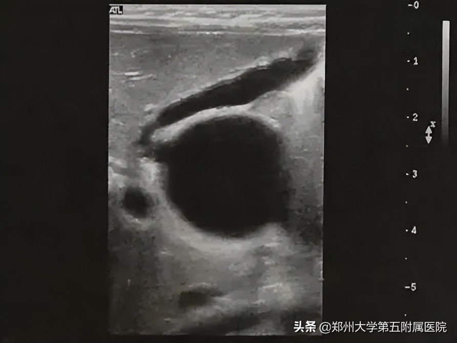 黄疸患者如何用超声诊断与鉴别,小儿黄疸超声筛查