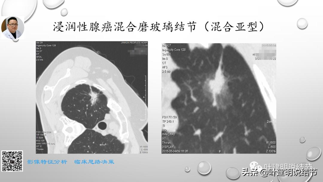 在《一脉阳光》呼吸影像诊断专题培训班上的讲课PPT（第一部分）