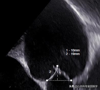 最先进的主动脉瓣二瓣叶畸形修复术（2020版）