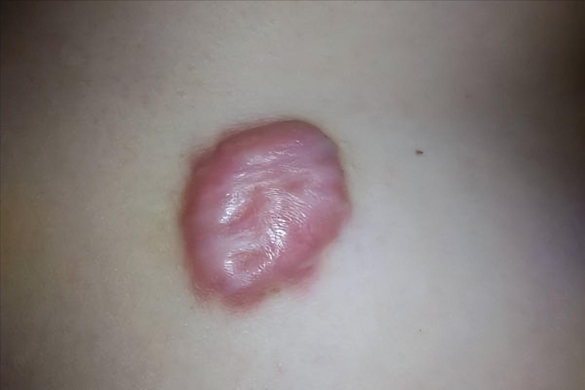 痘痘增生疤痕疙瘩怎么能彻底消除,如何分辨凸起的是痘痘还是疤痕