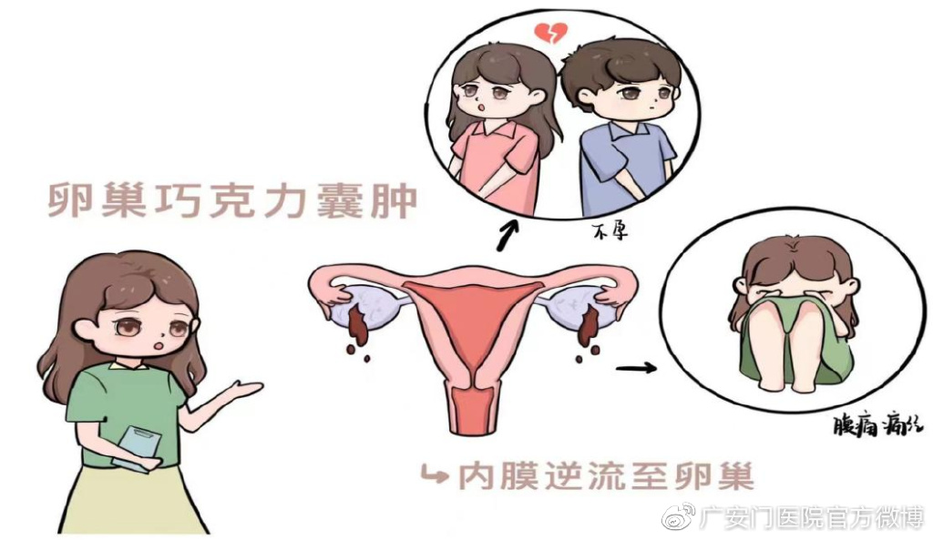 中医治卵巢囊肿巧克力囊肿,中医治疗卵巢巧克力囊肿能治好吗