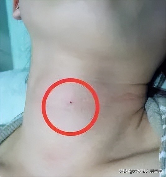 不用开刀也能治疗甲状腺结节？六安市人民医院这项技术了解一下
