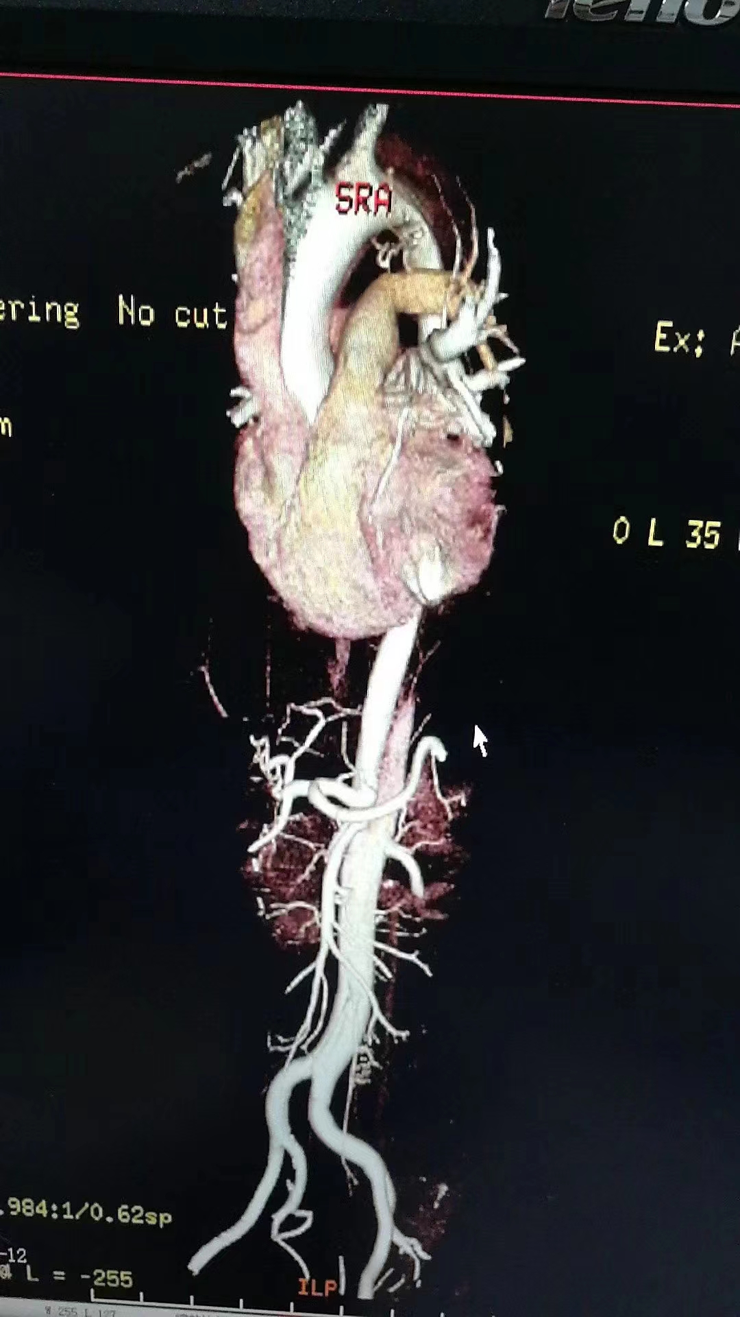 主动脉夹层心率太快,主动脉夹层的凶险