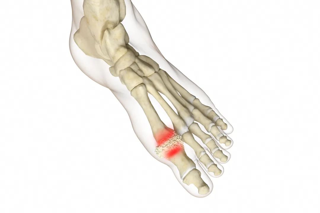 服药中痛风突然加重,吃药后痛风反复发作是怎么回事