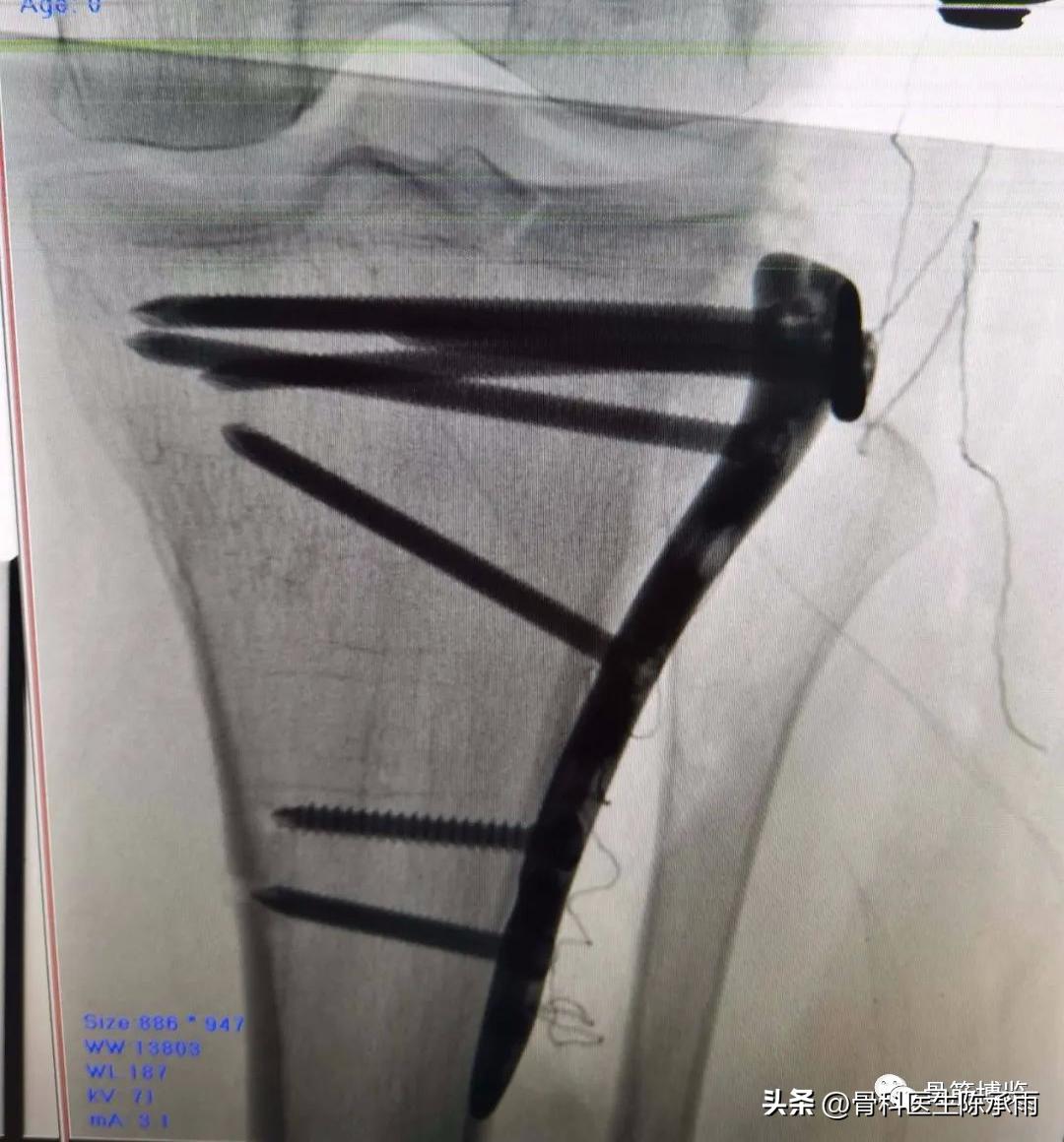 膝关节胫骨平台骨折,最近胫骨平台骨折视频