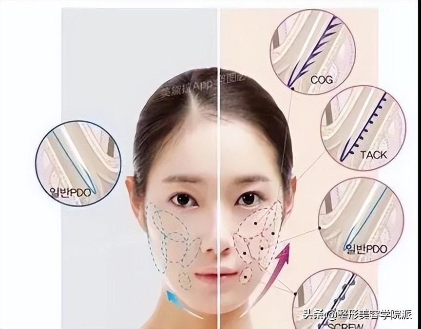 女29岁嘴角法令纹怎么办,脸部下垂法令纹做拉皮