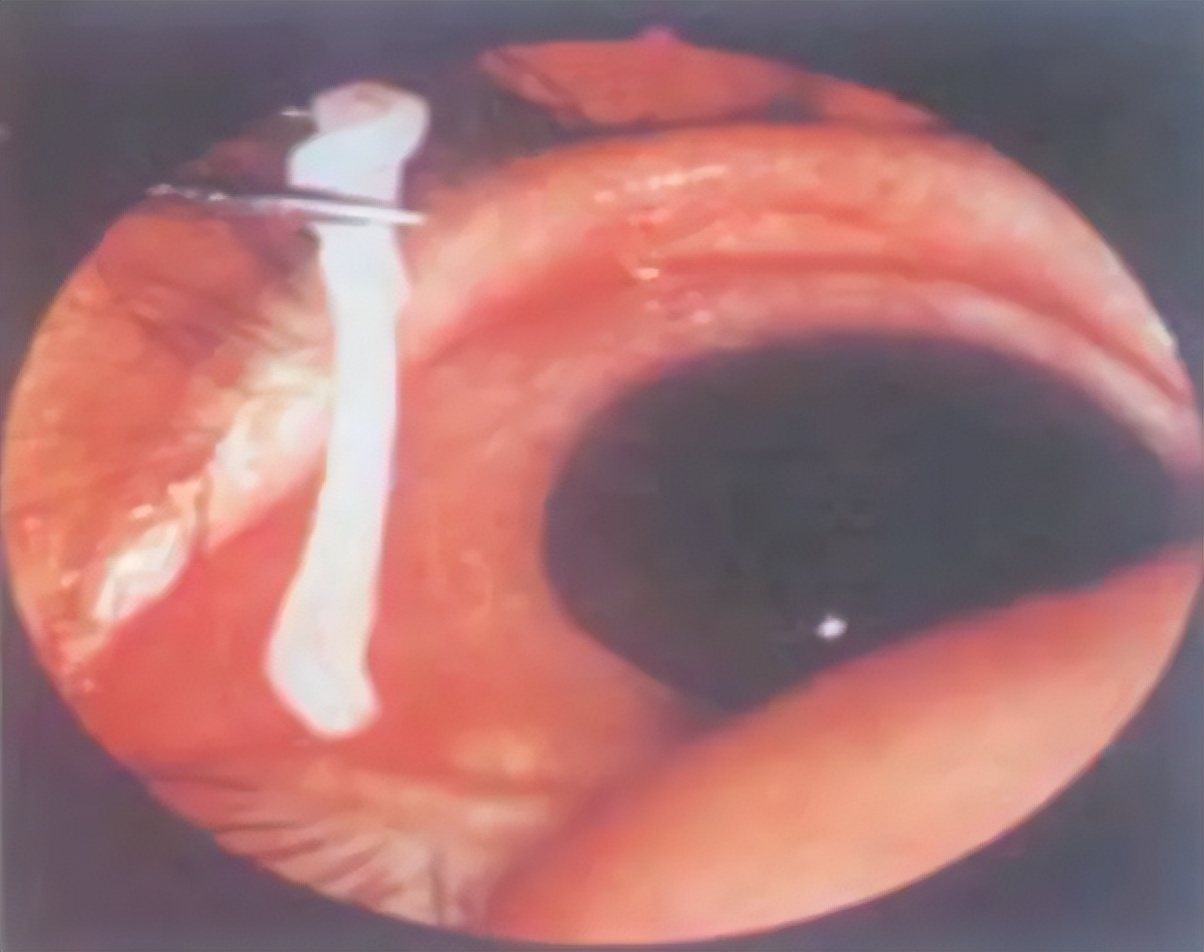 男子春节发现肝脏被掏空,男子腹痛肝脏被掏空