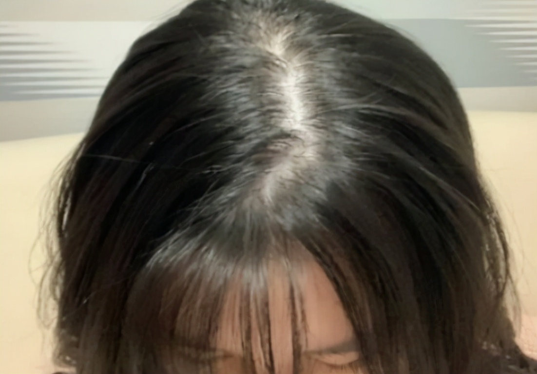 什么脱发用米诺和非那雄胺效果快,男性脱发用米诺地尔女性用什么