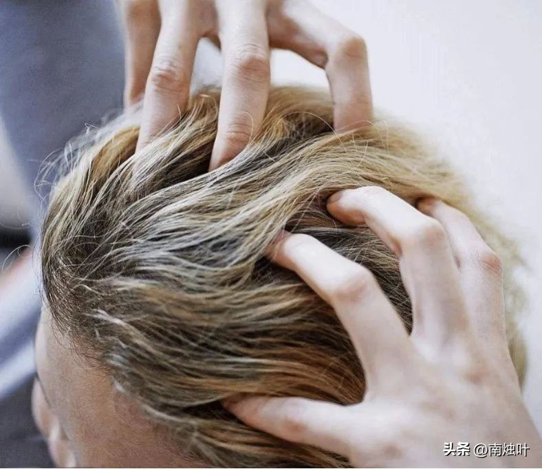 头油头痒头屑掉头发怎么治疗,头屑多头皮痒油头有什么好妙招