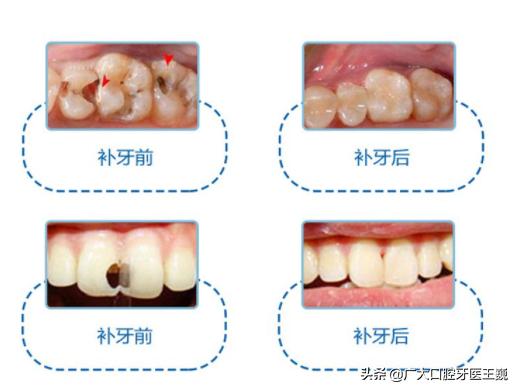 牙齿变得很白目前有几种方法,牙齿怎么才可以变白不伤牙