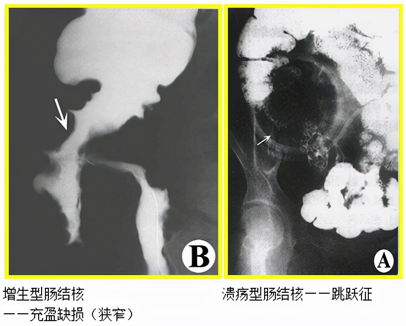 肺结核会传染给别人得肠结核吗,治疗肺结核的同时治疗肠结核吗