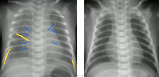 读完此文，终于会看儿童胸片了