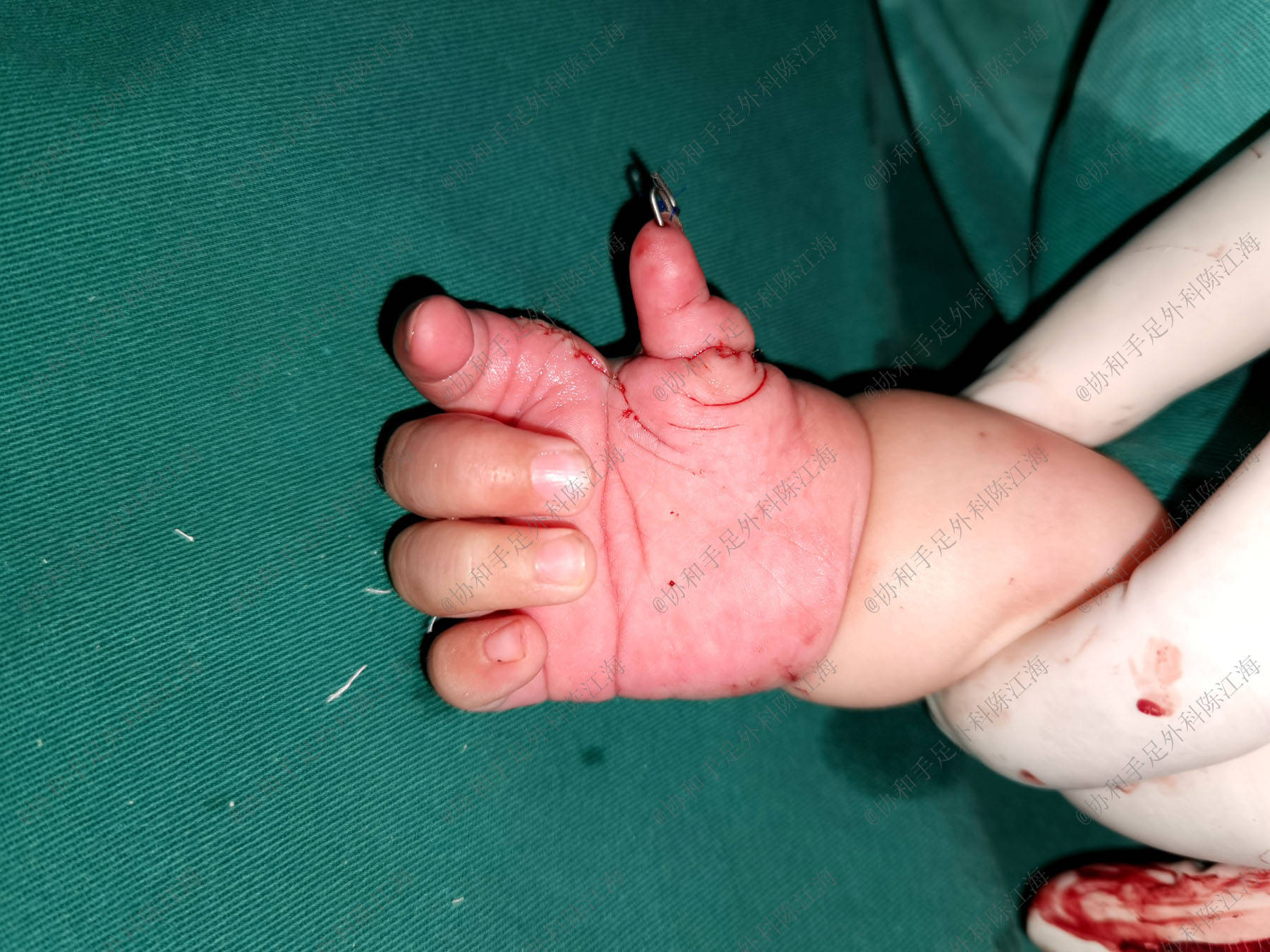 女儿是漂浮拇，拇指缺少骨头使不上劲，可以保留下来吗？